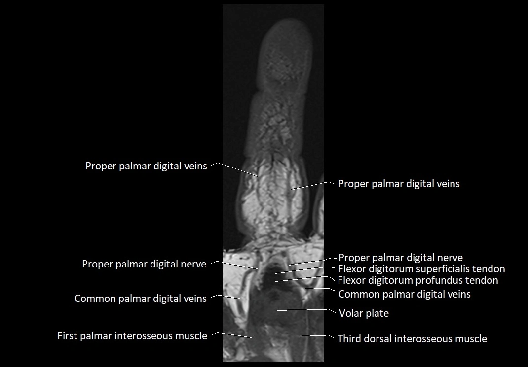 Finger anatomy coronal cross section 3TMRI labelled  image 9.webp